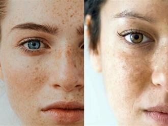 Sử dụng tranexamic trong chu trình skincare giúp giảm sắc tố và đốm đen trên da hiệu quả