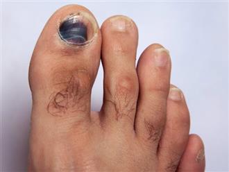 Bạn có lo lắng: Móng chân bị thâm đen là bệnh gì?