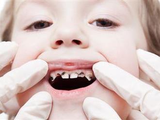 Dấu hiệu nhận biết trẻ em bị sâu răng và cách bảo vệ hàm răng chắc, đẹp