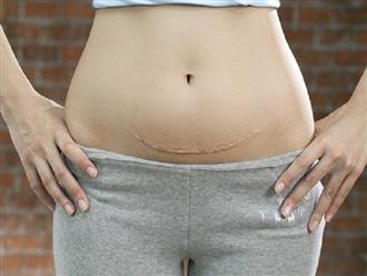Cách giảm mỡ bụng sau sinh mổ hiệu quả, an toàn