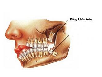 Những dấu hiệu và cách xử lý khi mọc răng khôn hàm trên