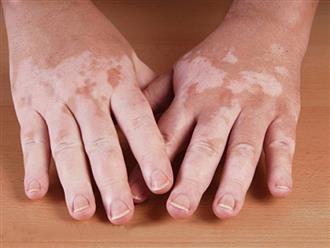 Tìm hiểu bệnh lý rối loạn sắc tố da ở tay và cách điều trị hiệu quả