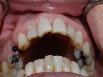 Sâu răng hàm trên và biện pháp chữa trị