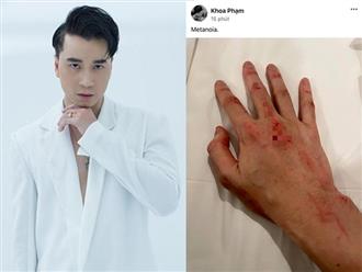 Karik bất ngờ đăng tải hình ảnh cánh tay trầy xước, đầy vết thương hậu tin đồn hẹn hò Quỳnh Lương