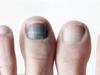 Chưa cần đi viện mà 4 dấu hiệu ở ngón chân thể hiện mỡ máu đang tăng cao