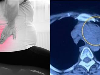 Đau lưng suốt thai kỳ, người phụ nữ ở Bắc Ninh được phát hiện ung thư phổi di căn
