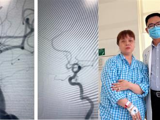Người phụ nữ 53 tuổi suýt mất mạng vì bị phình mạch máu não mà ngỡ… rối loạn tiền đình