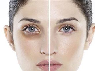 5 cách loại bỏ quầng thâm mắt hiệu quả