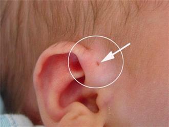 2% trẻ sơ sinh có đặc điểm này ở tai, mẹ nên chăm sóc kĩ