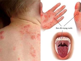 6 bệnh ngoài da hay gặp ở trẻ mùa nắng nóng