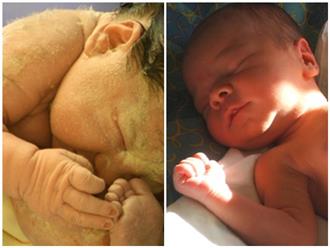 Mức độ nguy hiểm của bệnh vàng da ở trẻ sơ sinh theo ý kiến bác sĩ Nhi