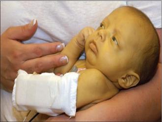 Trẻ sơ sinh bị vàng da: Dấu hiệu nhận biết, nguyên nhân và cách điều trị
