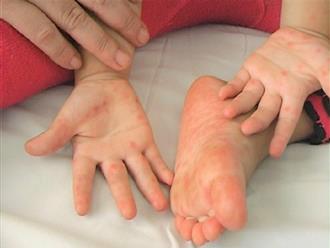 Virus chân tay miệng nặng ở trẻ em tái xuất, TP.HCM cảnh báo khẩn