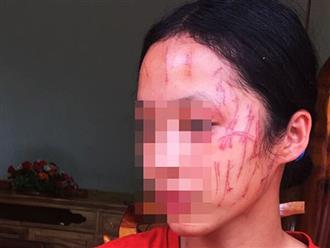 Nữ sinh lớp 8 bị bạn xô xát, chi chít vết thương trên mặt: Hé lộ nguyên nhân