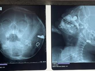 Bé gái 3 tuổi nhét pin điện tử vào mũi gây hoại tử 
