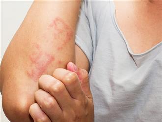 Bạn có biết: phát ban trên da là dấu hiệu ít phổ biến khi nhiễm SARS-CoV-2 nhưng không thể chủ quan