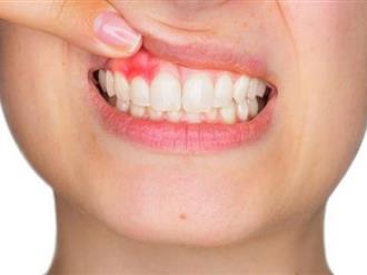 Mẹo vặt sức khỏe: Giảm đau do bị áp-xe răng khoa học nhất