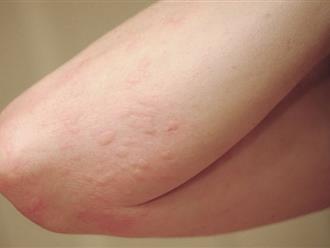Nổi mẩn đỏ ngứa như muỗi đốt cảnh báo những bệnh nguy hiểm nào?