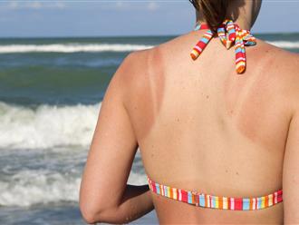 5 mẹo bảo vệ da khỏi cháy nắng trong mùa hè