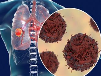 Gần 97% người ung thư phổi có thói quen cực xấu này, bỏ sớm trước lúc nội tạng bị phá hủy, hô hấp kém và suy tim