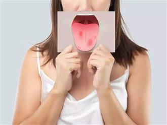 Những khu vực có thể cảnh báo 'ung thư miệng', Tết này ăn uống thỏa thích nhưng cần cẩn trọng viêm nhiễm lây lan