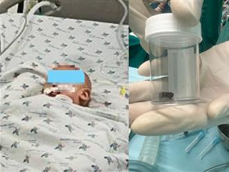 Bé trai 8 tháng tuổi nguy kịch sau khi nuốt cuống xoài, 2 bệnh viện phối hợp gắp ra