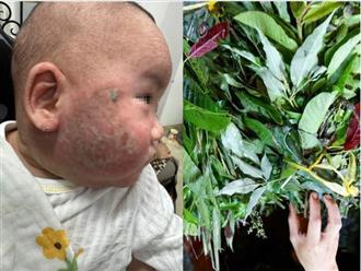Chữa viêm da cơ địa bằng tắm lá, bé trai 5 tháng tuổi phải nhập viện vì biến chứng nặng