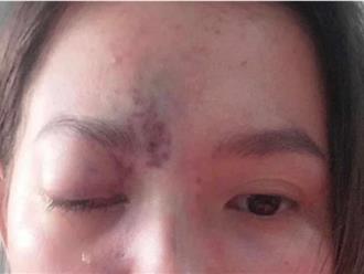 Người phụ nữ mù mắt sau khi tiêm filler làm đẹp tại một spa ở TP.HCM