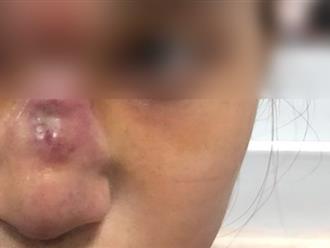 Nữ bệnh nhân gặp hoạ vì mũi biến dạng, chảy dịch sau khi nâng mũi tại cơ sở thẩm mỹ