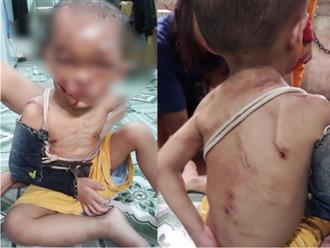 Sức khỏe hiện tại của bé trai 2 tuổi nghi bị bạo hành ở TP.HCM: Cha đánh đập suốt 3 ngày qua