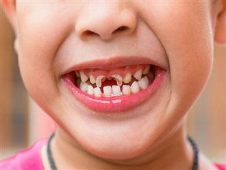 Những căn bệnh răng miệng thường gặp ở trẻ nhỏ, bố mẹ phải đặc biệt quan tâm
