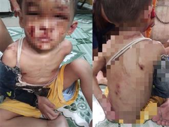 Tình trạng sức khỏe 'đáng lo ngại' của bé trai 2 tuổi nghi bị bố mẹ bạo hành ở TP.HCM