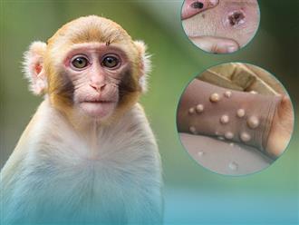 Nóng: Đồng Nai ghi nhận ca bệnh đậu mùa khỉ đầu tiên, ca thứ 3 cả nước 