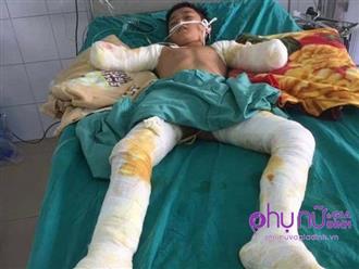 Nhói lòng lời cầu cứu của nam sinh lớp 7 bị cắt cụt 2 tay vì điện giật: 'Xin cứu đôi chân của con'