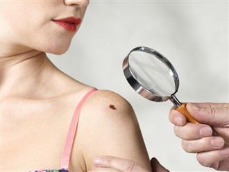 Cẩn thận với 5 dấu hiệu bất thường của nốt ruồi cũng có thể cảnh báo nguy cơ mắc bệnh ung thư da