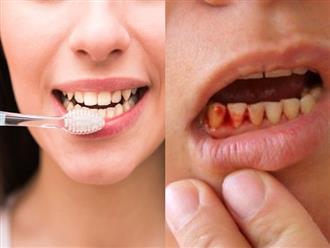 Dấu hiệu cơ thể mắc bệnh nguy hiểm khi thường xuyên chảy máu chân răng trong lúc đánh răng