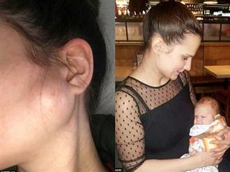 Phát hiện vết sưng nhỏ trên mặt trước khi sinh, người mẹ trẻ đâu ngờ sau 2 tuần lại trở thành khối u ác tính và cô mắc bệnh ung thư giai đoạn cuối