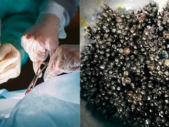 Bác sĩ 'sởn gai ốc' khi phát hiện có hơn nghìn viên sỏi mật trong cơ thể cụ bà 73 tuổi