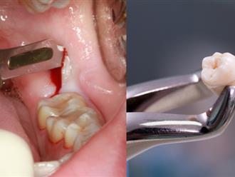 Những biến chứng có thể ai cũng sẽ phải gặp sau khi nhổ răng khôn 