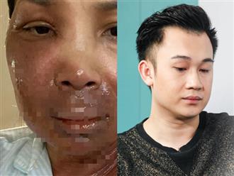 Tâm sự xúc động em trai Hoài Linh gửi Hồng Ngọc khi chứng kiến ảnh 2/3 gương mặt bỏng nặng của đàn chị