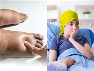 Thấy chân có những dấu hiệu này nên đi khám ngay lập tức, ung thư có thể ‘gõ cửa’ lúc nào không hay