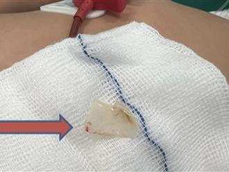 Trẻ 2 tuổi ở TP.HCM nhập viện giữa trưa vì hóc xương khi ăn cháo cá lóc ngày Tết