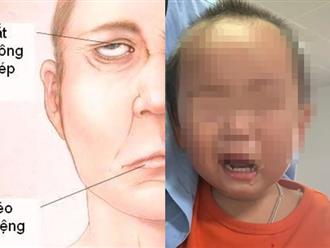 Trời rét đậm, rét hại, bé 2 tuổi nhập viện trong tình trạng méo miệng, liệt dây thần kinh số 7