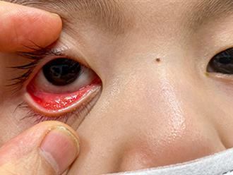Trẻ bị đau mắt đỏ, nhiều người tin vào 'kinh nghiệm online', nhỏ sữa mẹ vào mắt, bác sĩ cảnh báo 'rước bệnh vào người'