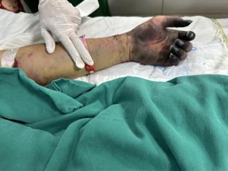 Nam bệnh nhân nguy kịch do vi khuẩn trong món tiết canh, nhập viện với bàn tay tím đen, hoại tử