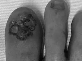Mất móng chân cái vì ung thư da mà không biết, người phụ nữ nhập viện khẩn cấp
