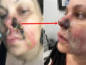 Người phụ nữ 52 tuổi nghiện tiêm filler suốt 20 năm: Sụt cân kinh hoàng, một bên mũi mục nát, phải đeo mũi giả vì không còn tiền tái tạo 