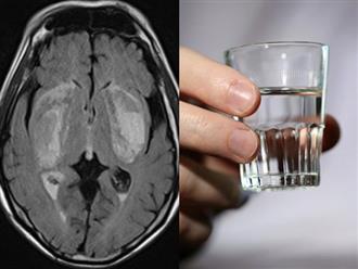 Pha cồn với nước lọc để uống, 2 người đàn ông nhập viện do ngộ độc methanol, bị mù mắt, tổn thương não