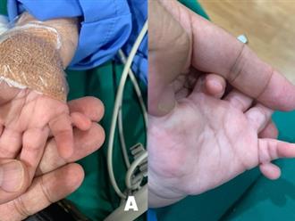 Hy hữu: Bé gái sinh ra với 24 ngón tay, chân, phải phẫu thuật mới có thể cầm nắm