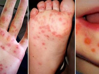 Thời tiết mùa Đông - Xuân khiến thuỷ đậu, tay chân miệng gia tăng: Xuất hiện chùm ca bệnh trong trường học ở Hà Nội